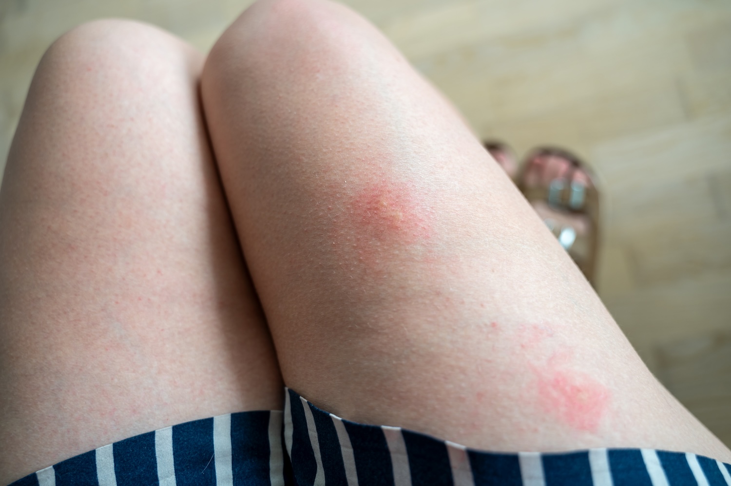 bug bite boggio pharmacy 2