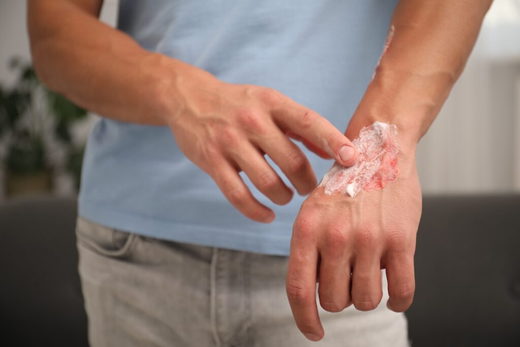 Dry, Itchy Skin? How to Manage Eczema as the Weather Gets Colder