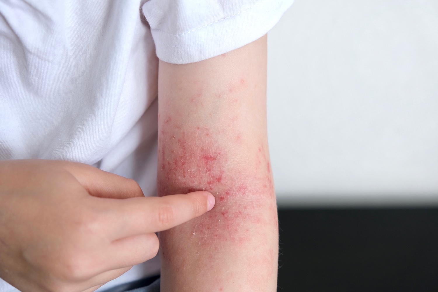 Dry, Itchy Skin? How to Manage Eczema as the Weather Gets Colder